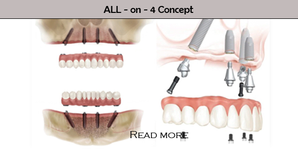 Educational diagram of the All-on-4 dental implant concept, showing a full prosthetic arch supported by four implants