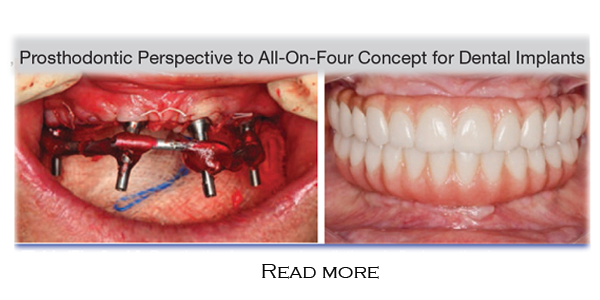 Medical illustration showing a prosthetic dental bridge being placed onto implants in the lower jaw